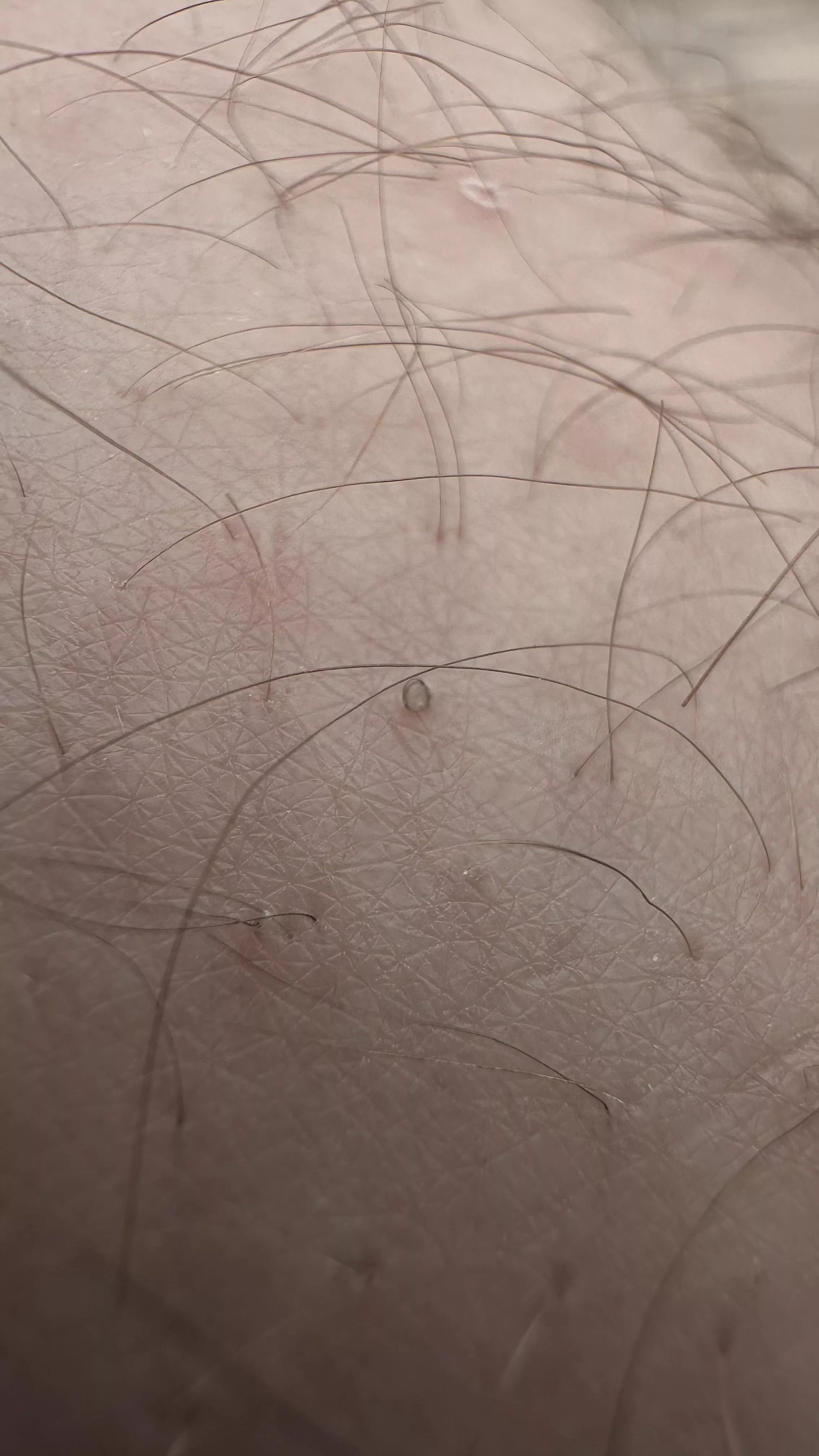 My husband gets what we call “uzumakis”