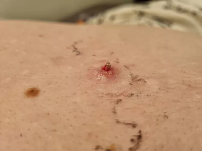 Old picture of a large, red thing brewing up. It popped on it's own under a bandaid and needed only a gentle push to get this hard nugget out of it. Instant relief.