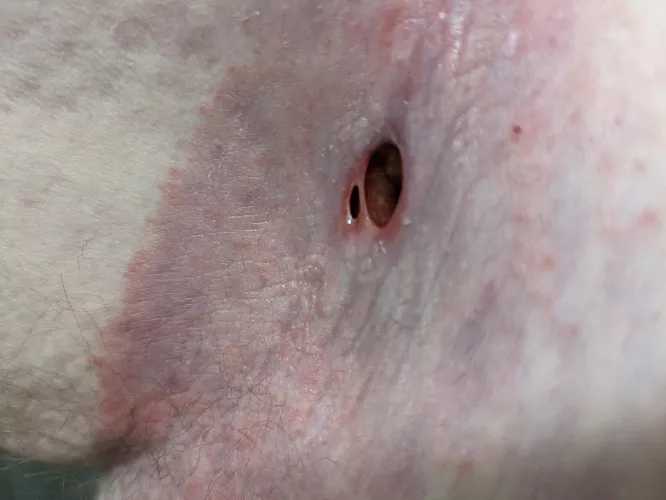 The swelling went down and a new hole formed