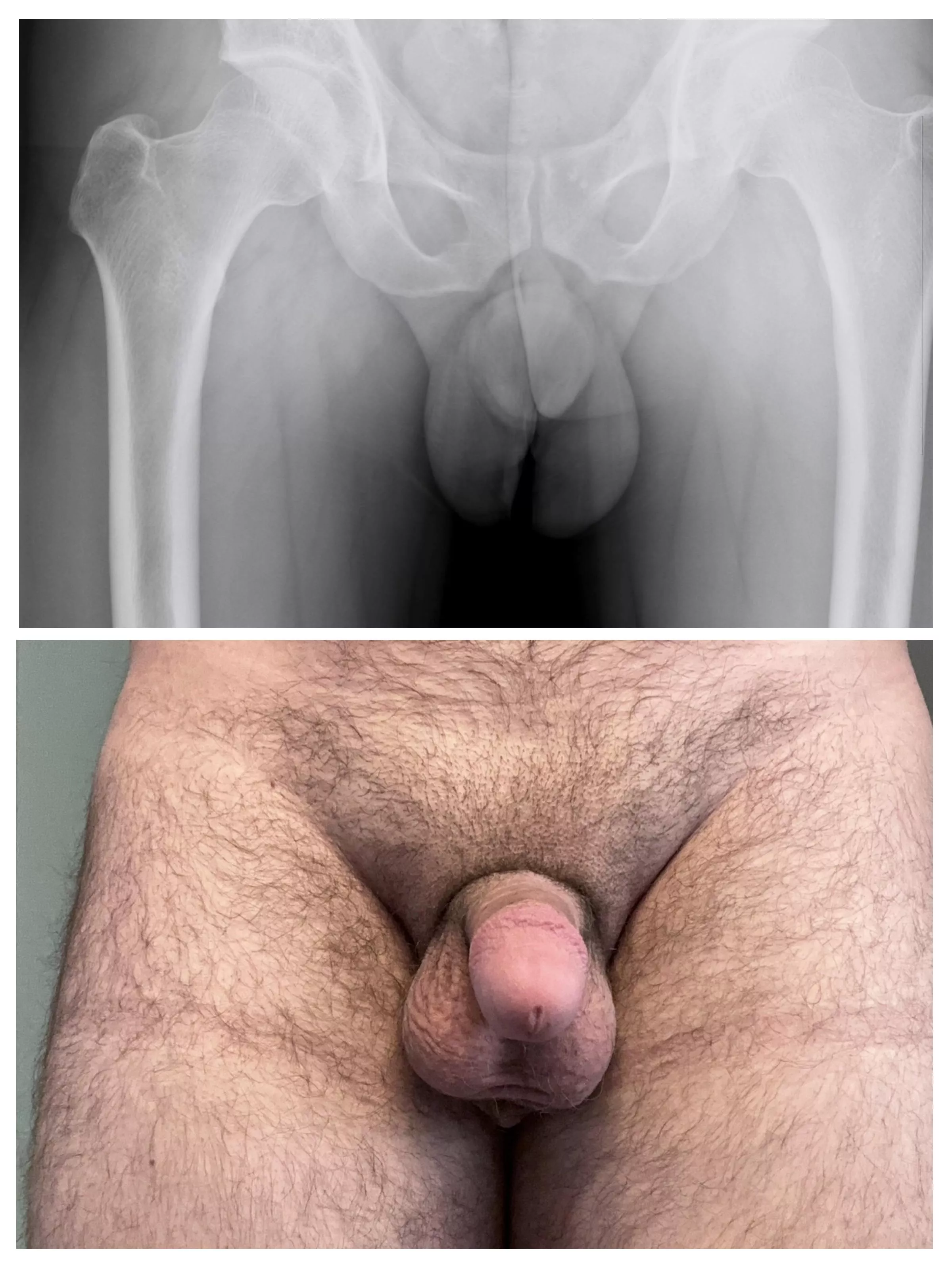 X-Ray Softie and Normal Softie.