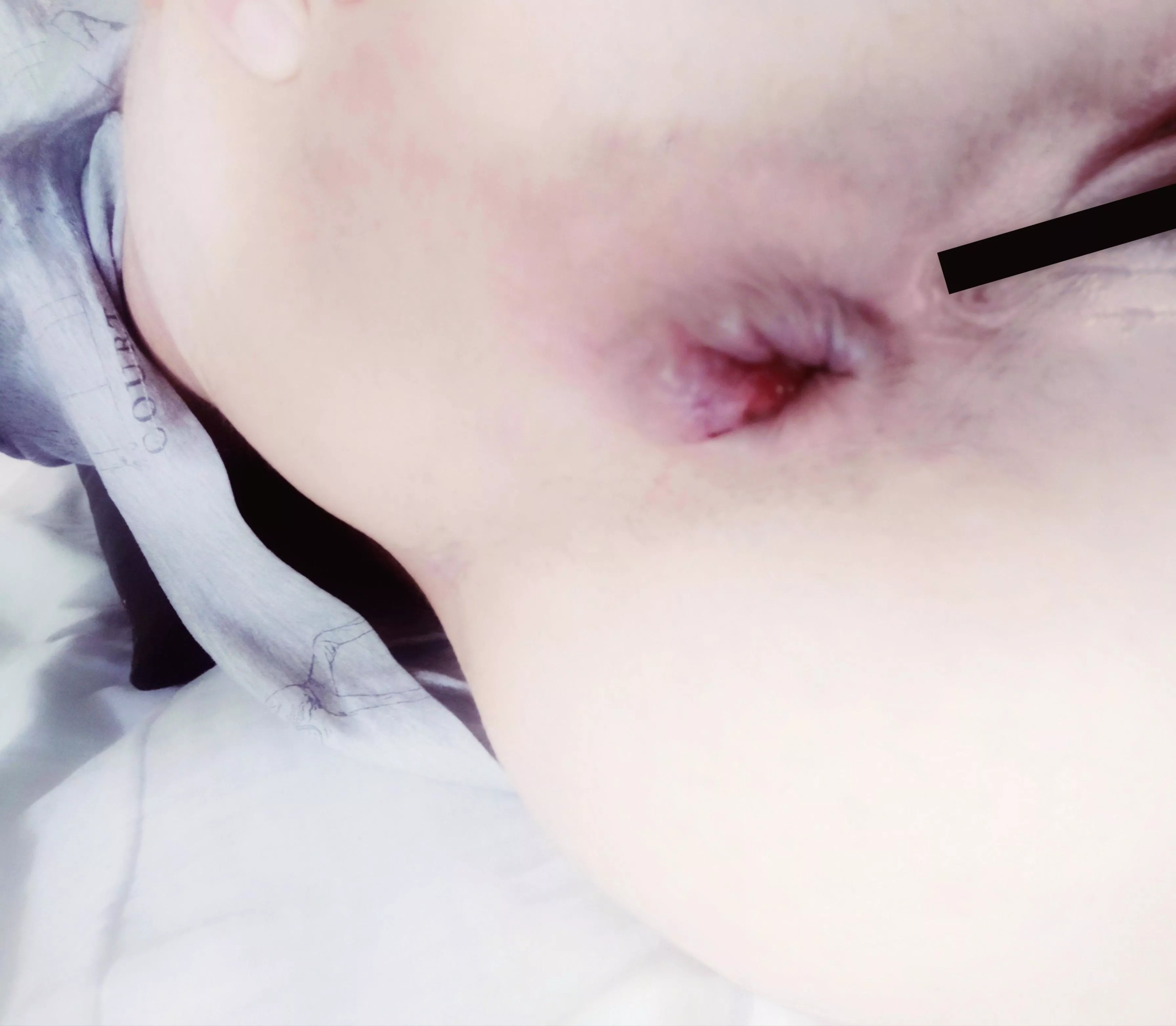 My hole after some hard anal fisting 😳 (oc) f 28 