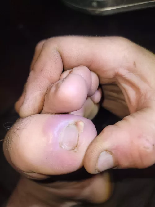 Got a staph infection under my toenail. Oh, the relief