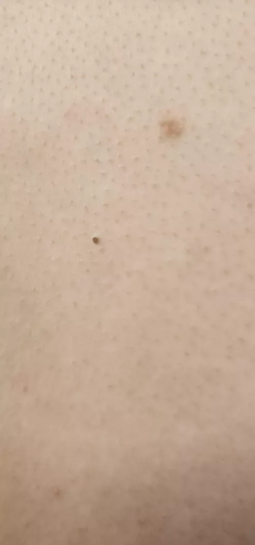 I so wish my roomie would let me pop this blackhead. You can tell it's a fat boy.