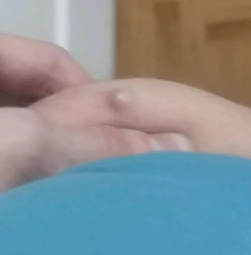 Safe to pop with a needle ? Rooted deep down on my ass...