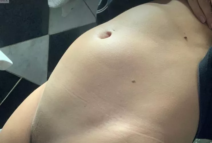 Eating pasta leaves me bloated like this