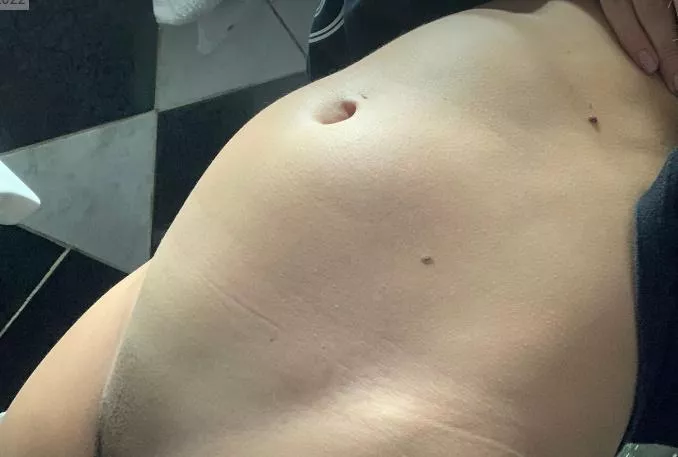 Eating pasta leaves me bloated like this