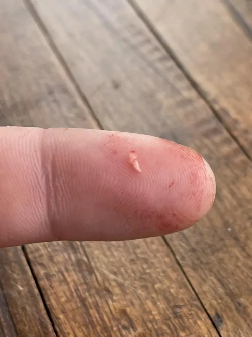 Angry Painful Butt Cheek Cyst