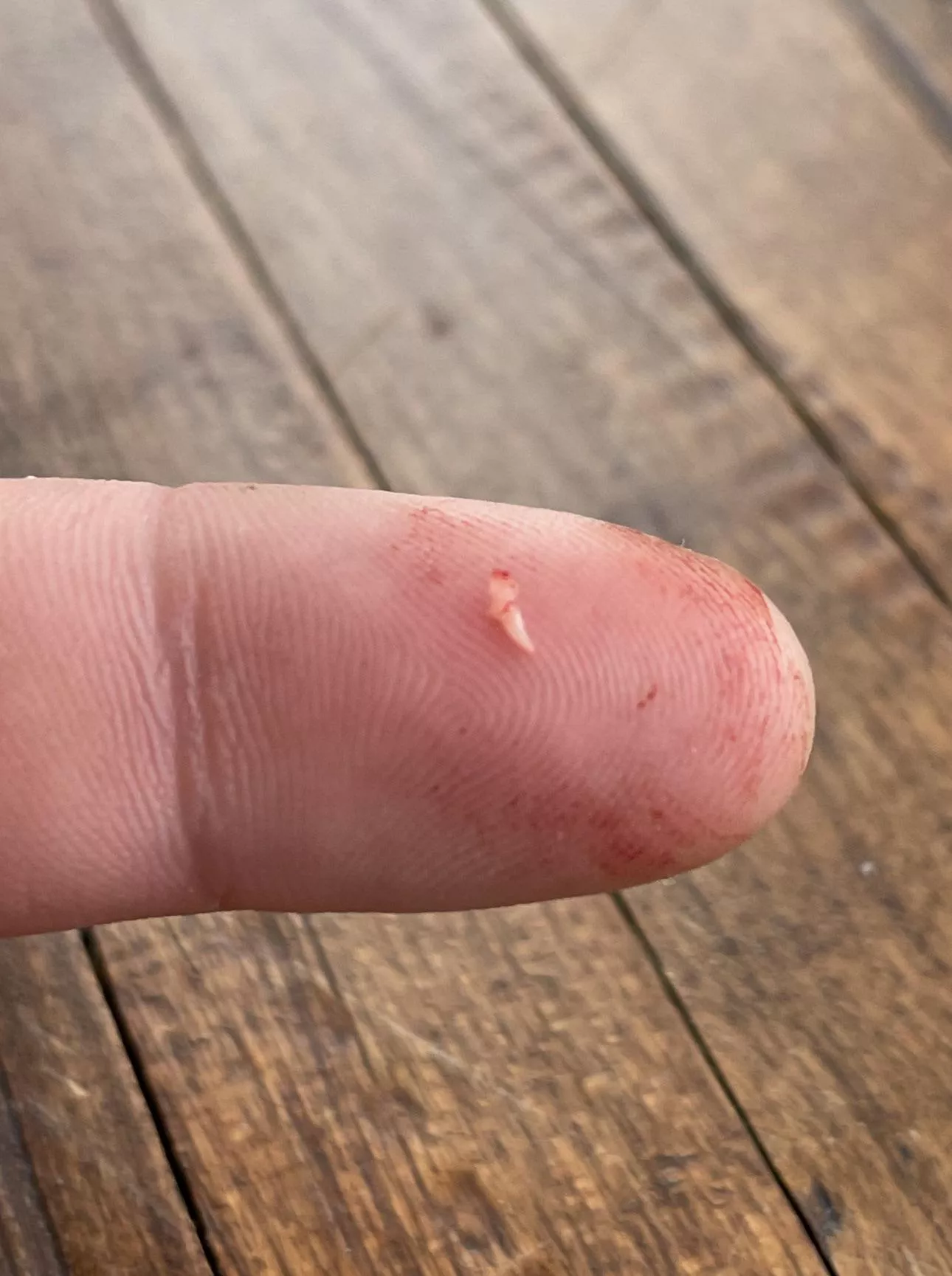 Angry Painful Butt Cheek Cyst