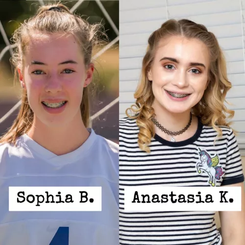 Which brace face would you glaze? [2]