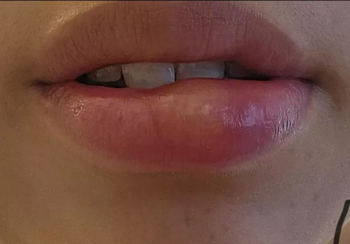 cold sore fetish?