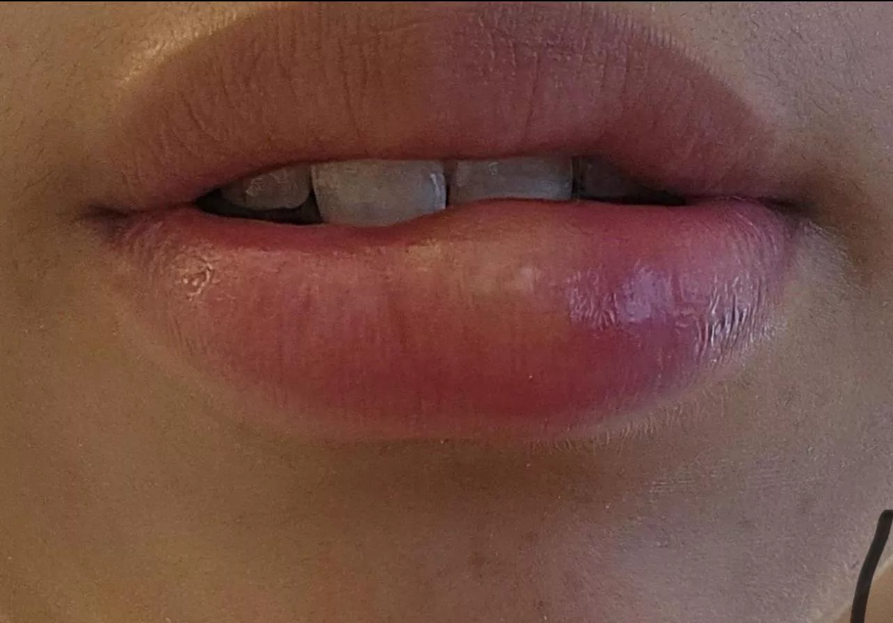 cold sore fetish?