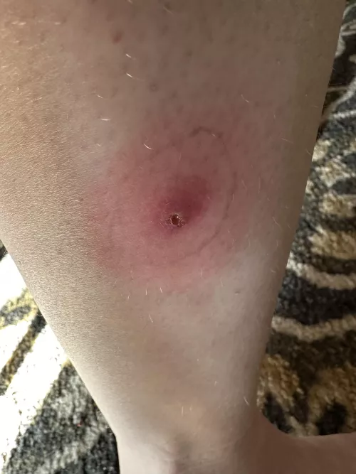 What started as I thought an ingrown, turned into this.