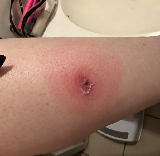 A fun lil update on my leg