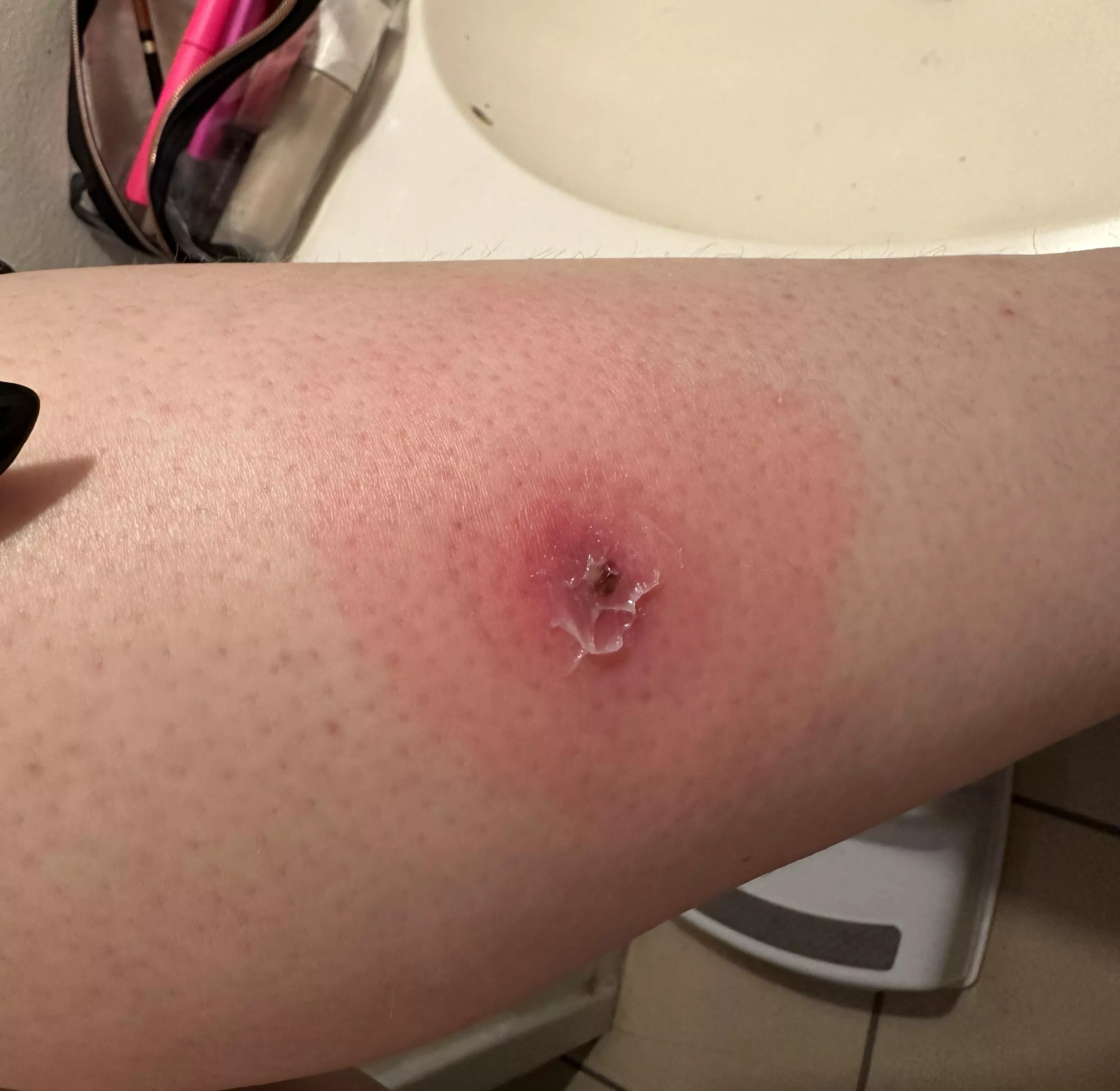 A fun lil update on my leg