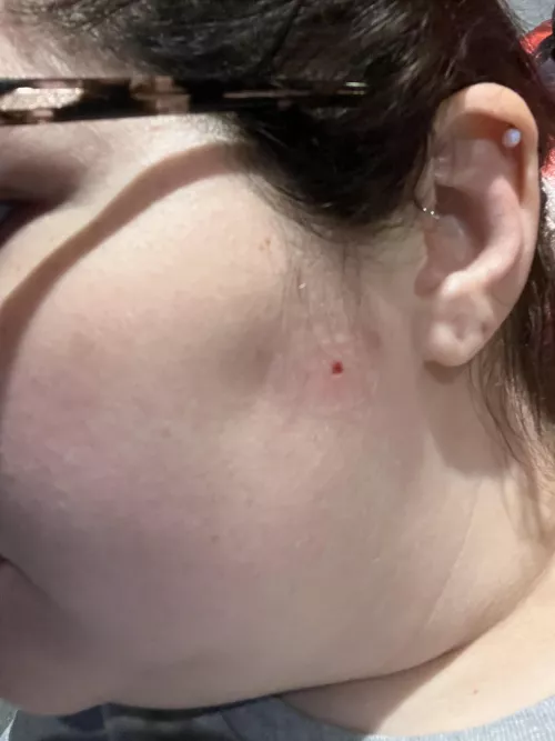 Had an irregular shaped mole shaved off my face today. It’s very red around it because I’m allergic to adhesive. Doctor sent it for biopsy and said they’ll call in the next few days. Fingers crossed it’s benign🤞🏻