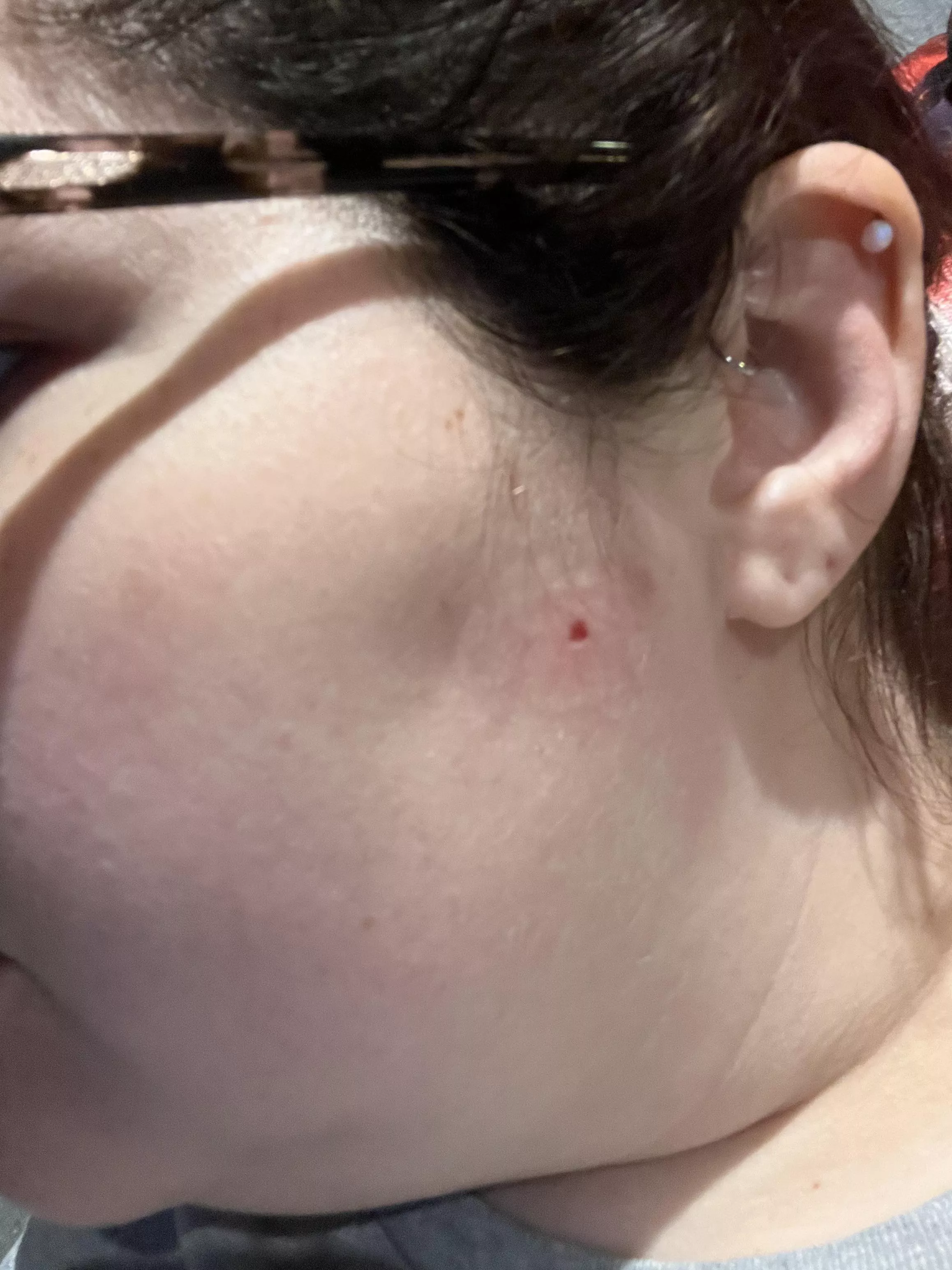 Had an irregular shaped mole shaved off my face today. It’s very red around it because I’m allergic to adhesive. Doctor sent it for biopsy and said they’ll call in the next few days. Fingers crossed it’s benign🤞🏻