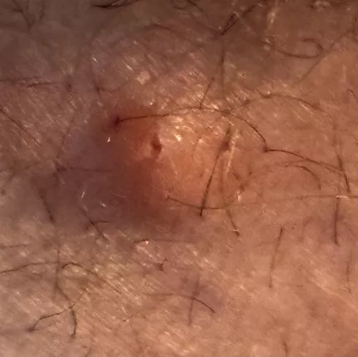 Inner thigh boil that accidentally got popped! What do I do?