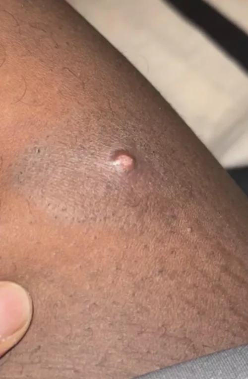 What is this under my thigh, Cyst or Pimple?