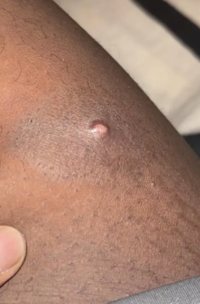 What is this under my thigh, Cyst or Pimple?