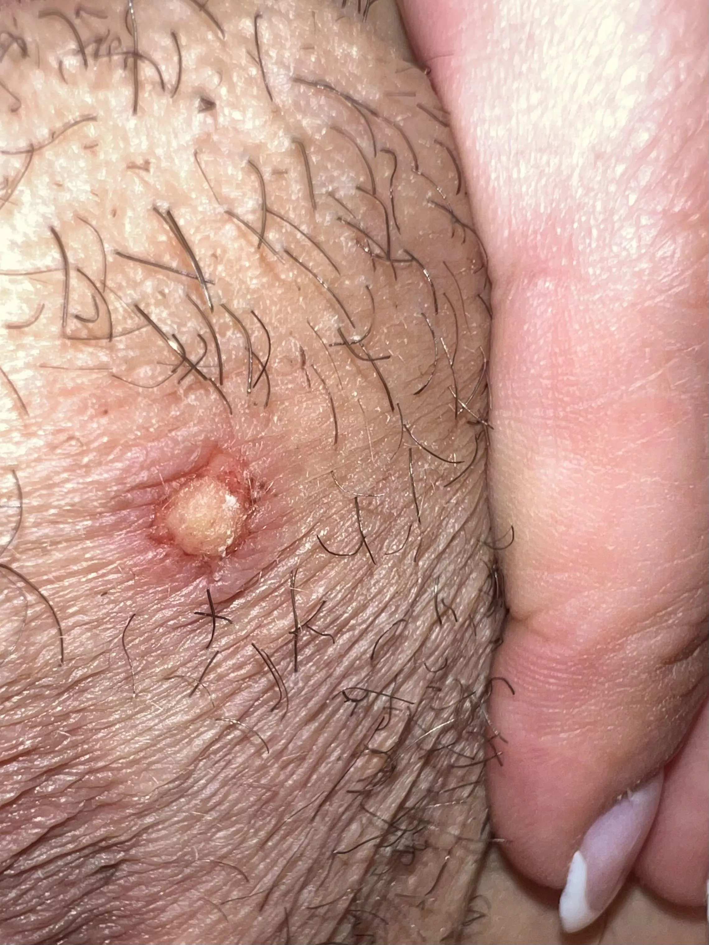 Dug too deep for ingrown hair & scraped layer of skin off