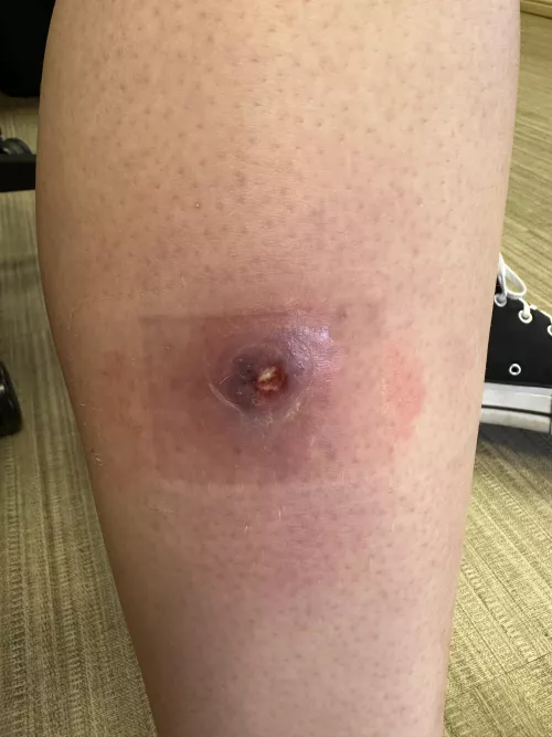 Cellulitis girl update!