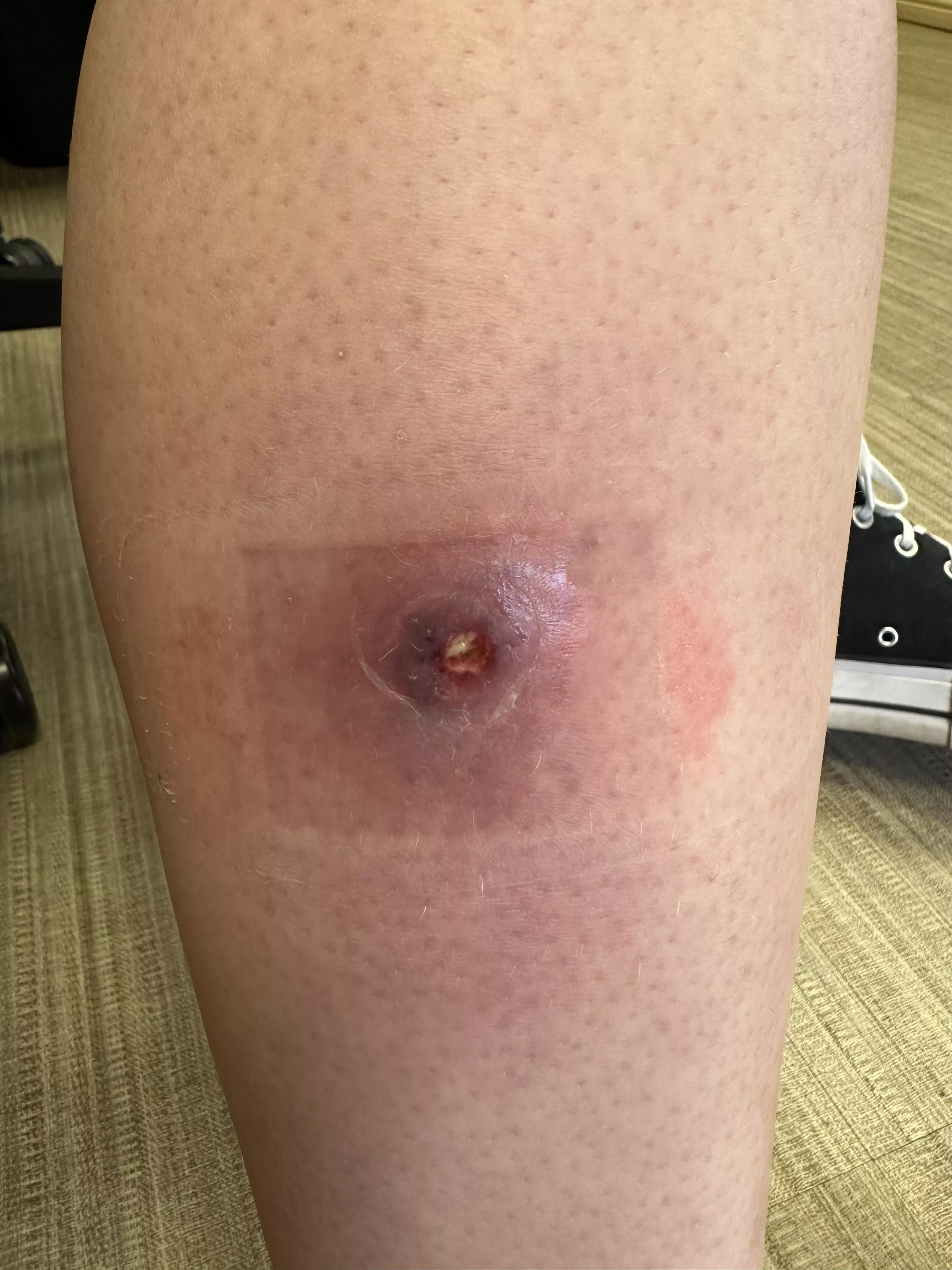 Cellulitis girl update!