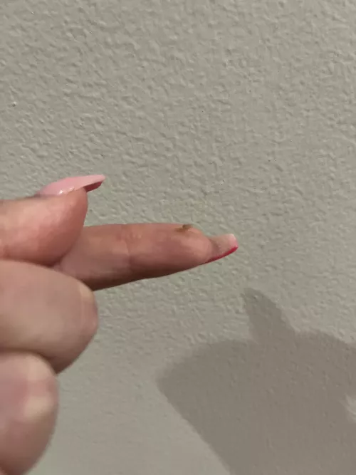 Finally got this sucker out of my scalp 