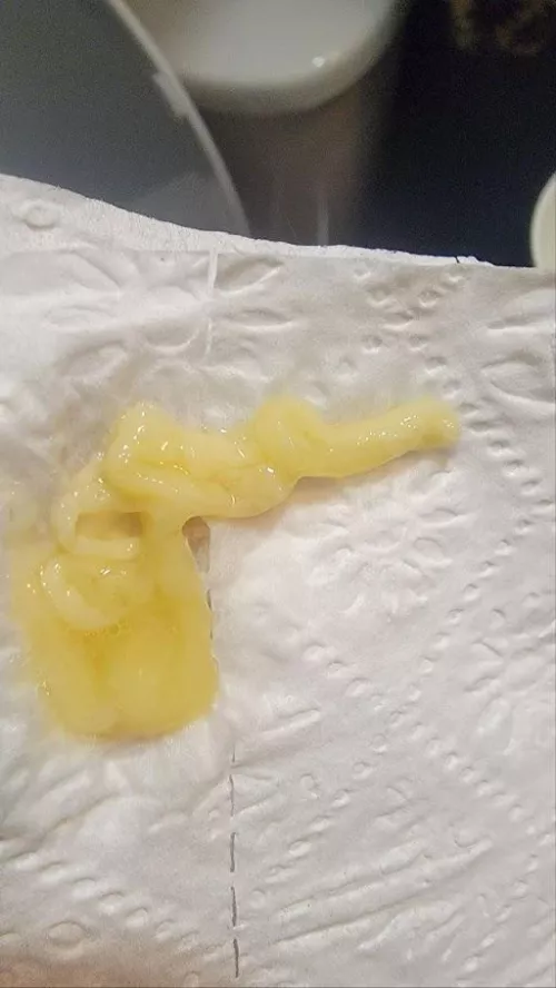 I had pneumonia a few weeks ago and coughed up casts like this a couple times a day.