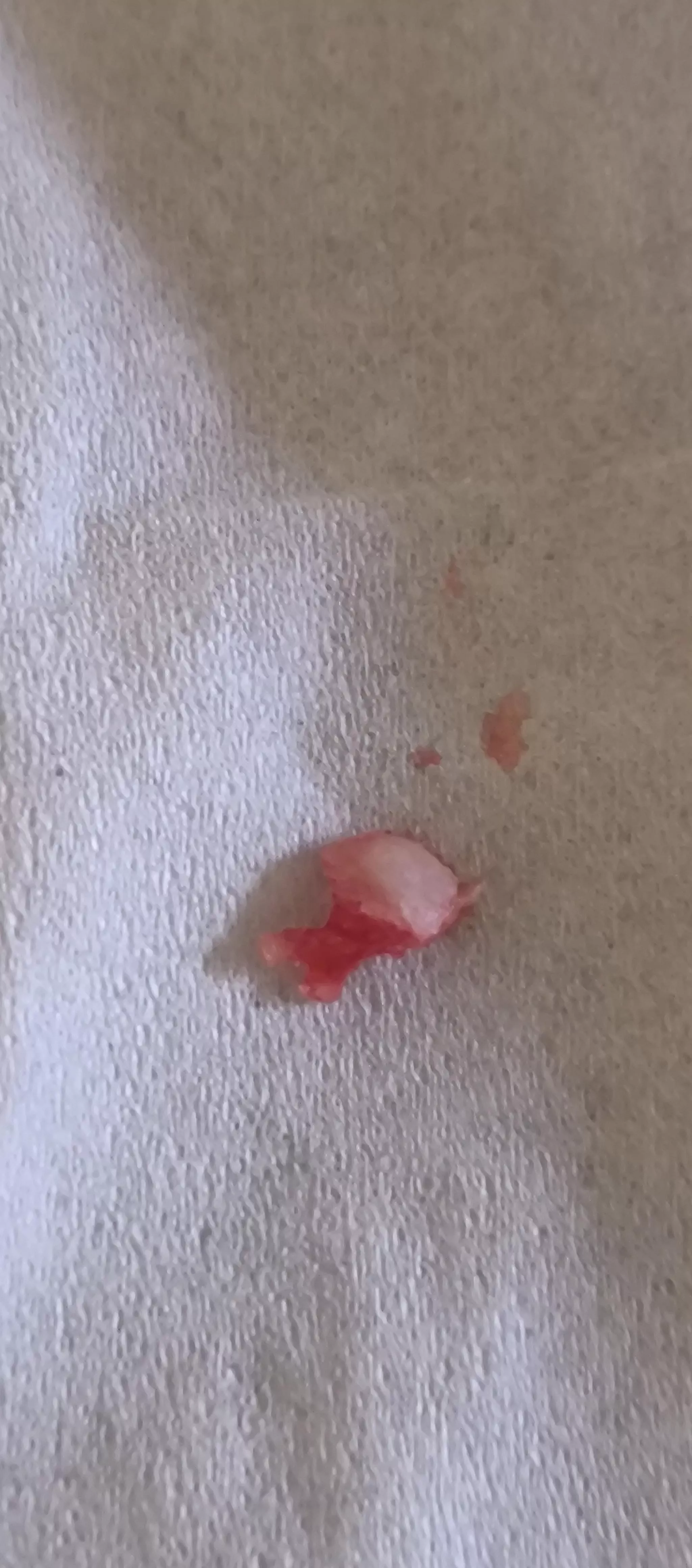 Shard of bone came out my gum