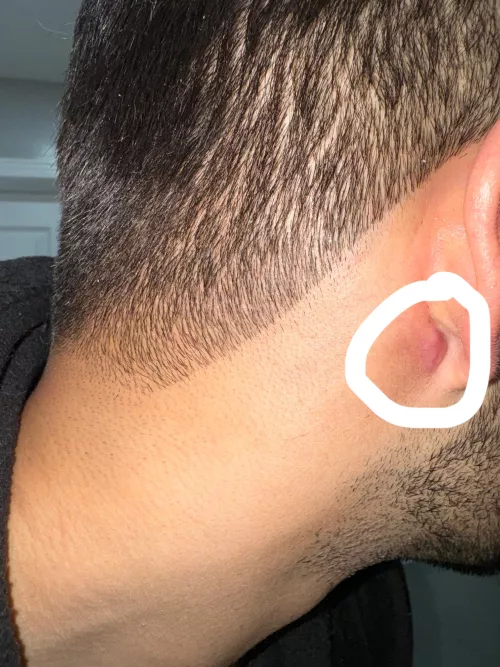 Best way to heal drained cyst? Scab already formed and fell off 