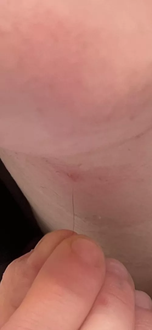 Finally got this ingrown hair out that’s been hiding for a year
