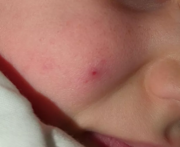 Forbidden Pop: cyst on my kid's face