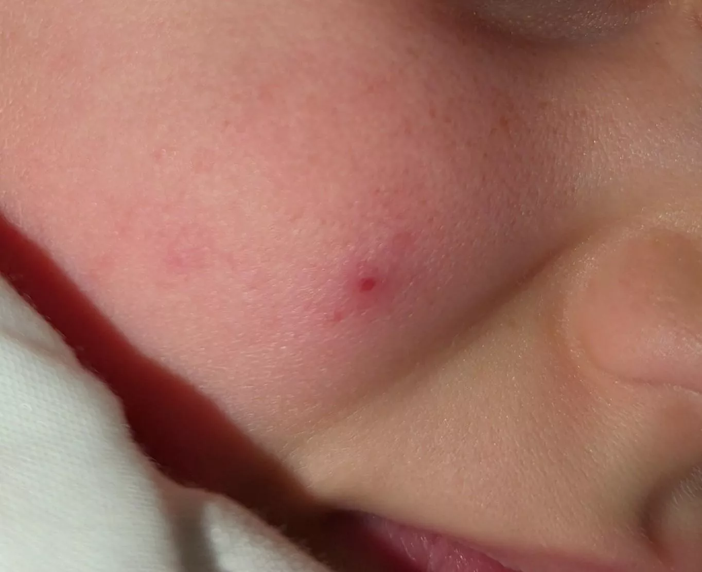 Forbidden Pop: cyst on my kid's face