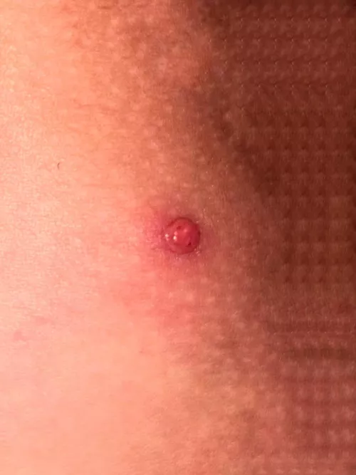 Pimple or boil on my thigh/butt