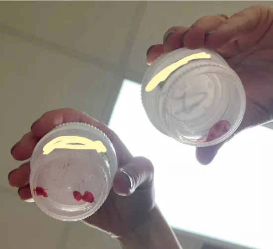 2 Pilar Cysts Removed