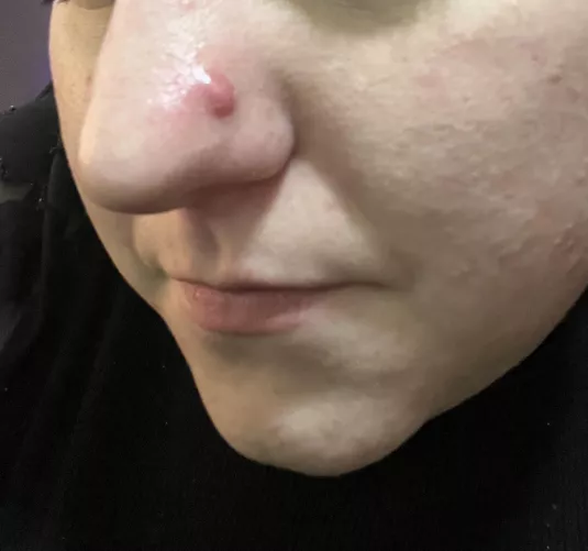 Evil Cyst on my nose