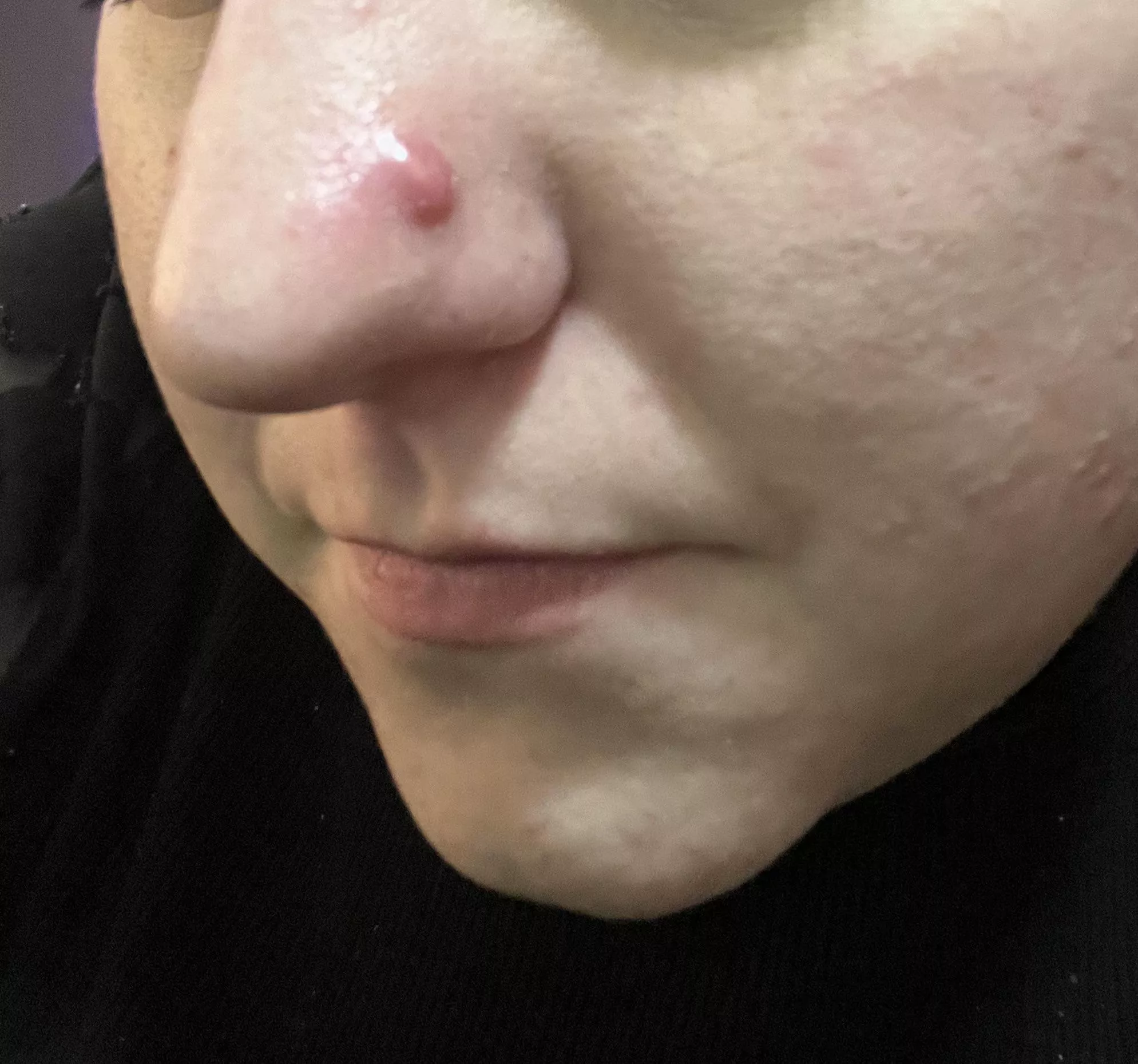 Evil Cyst on my nose
