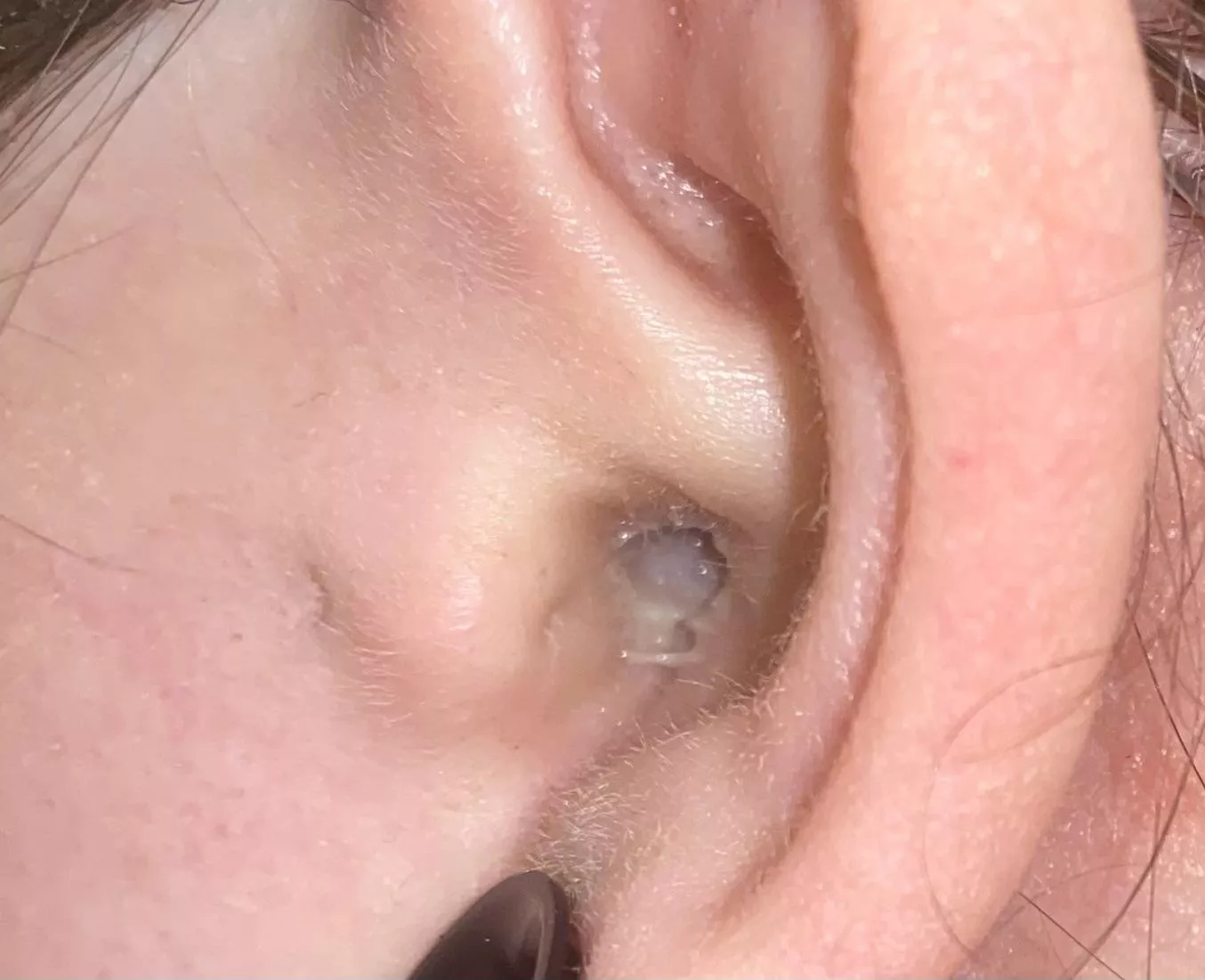 Super painful ear infection with pus ! 