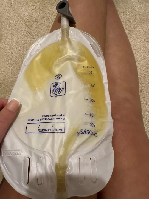 21 F with a catheter 