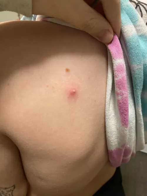wanted to share my back pimple