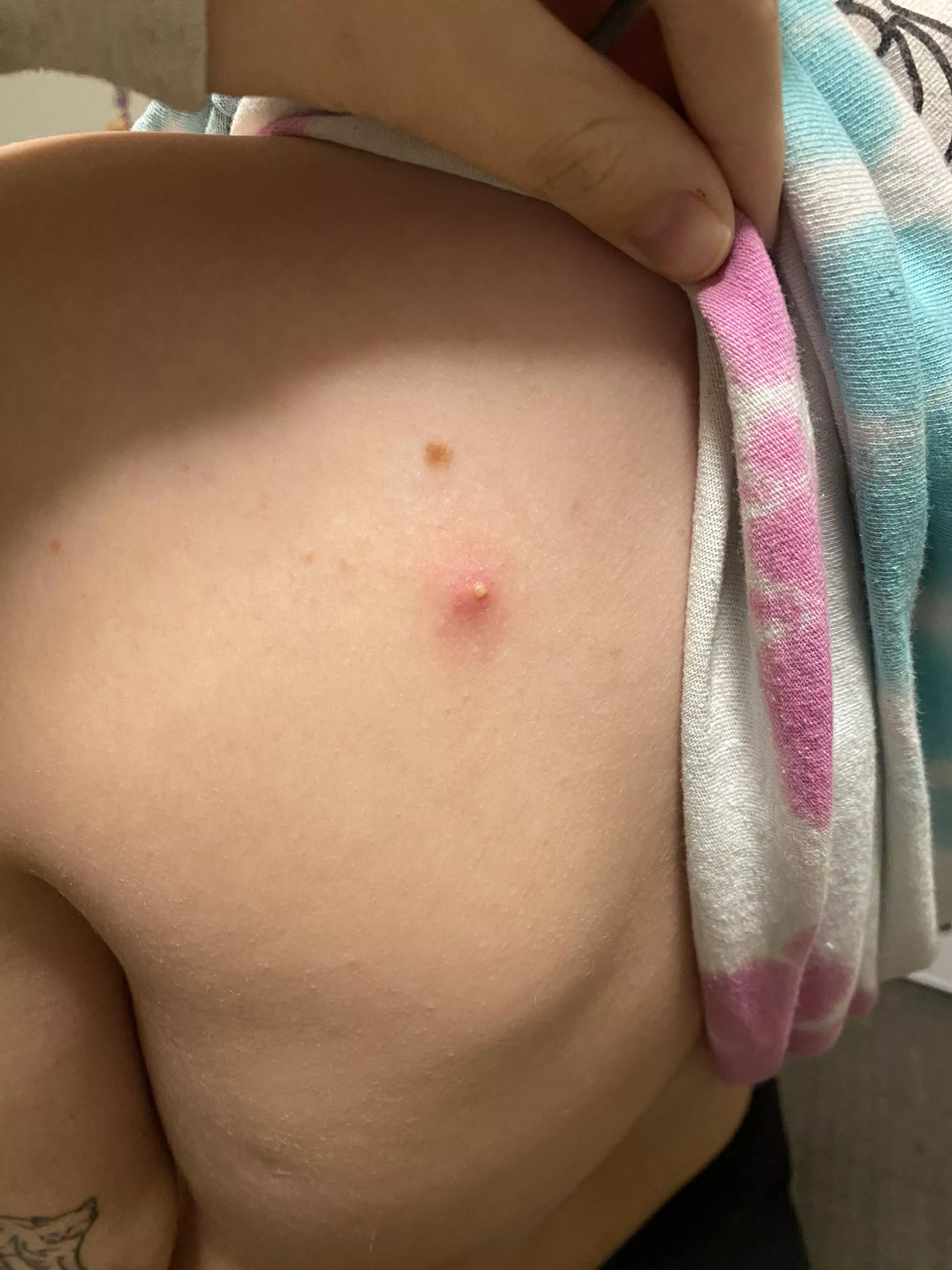 wanted to share my back pimple