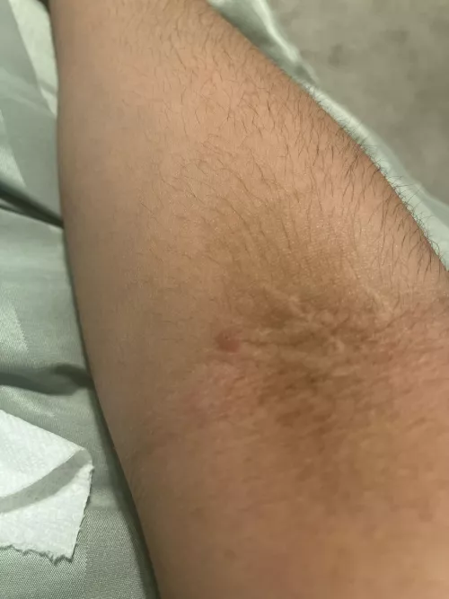 what is this weird bump on my arm.