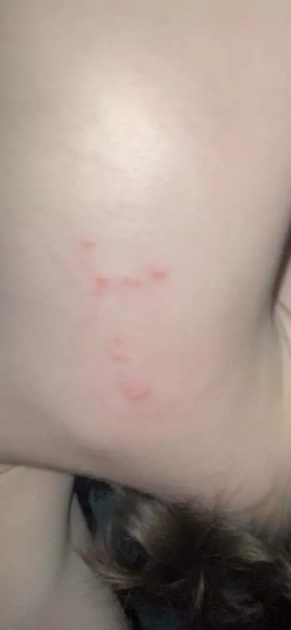 what kind of rash is this? i have them all over