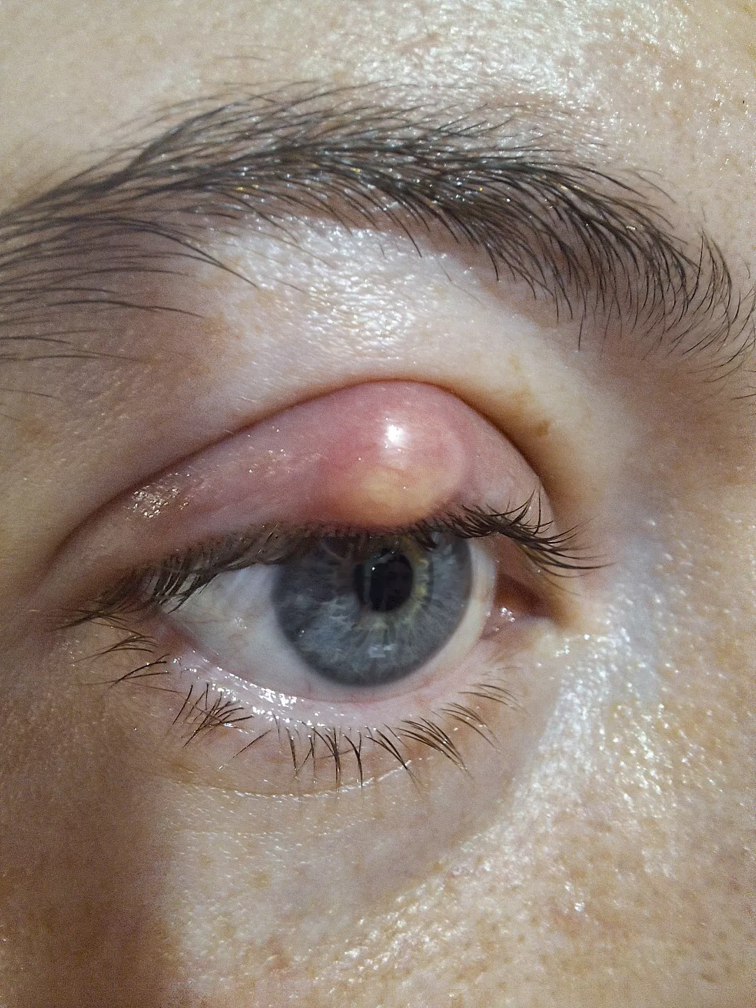 Chalazion/stye going to pop