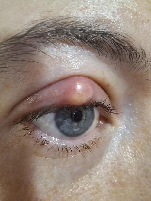 Chalazion/stye going to pop?