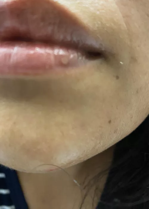 Is this a cold sore never had one