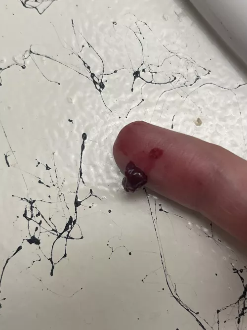 Super painful temple abscess