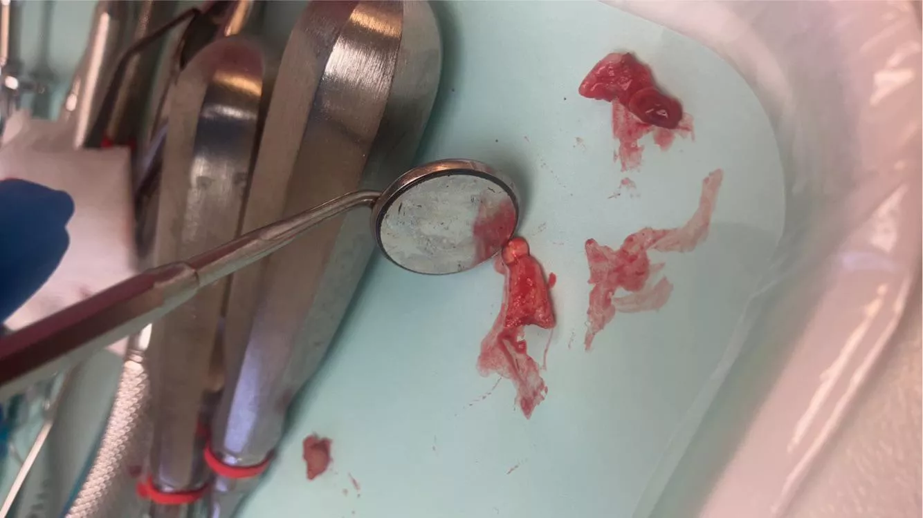 Had emergency oral surgery to remove an infection from an old root canal…