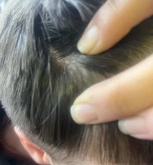 Is this a mole or cyst??