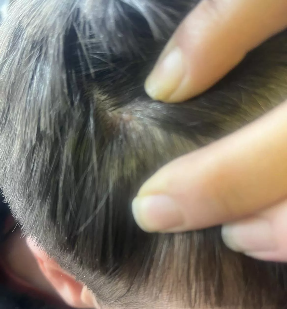 Is this a mole or cyst??